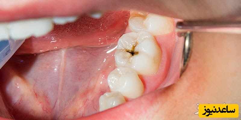 علائم پوسیدگی ریشه دندان