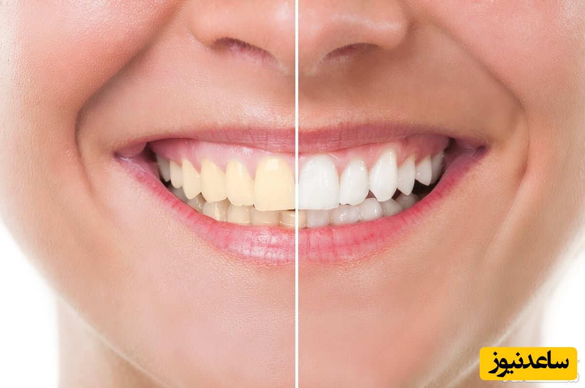 باندینگ دندان چیست و روش انجام آن
