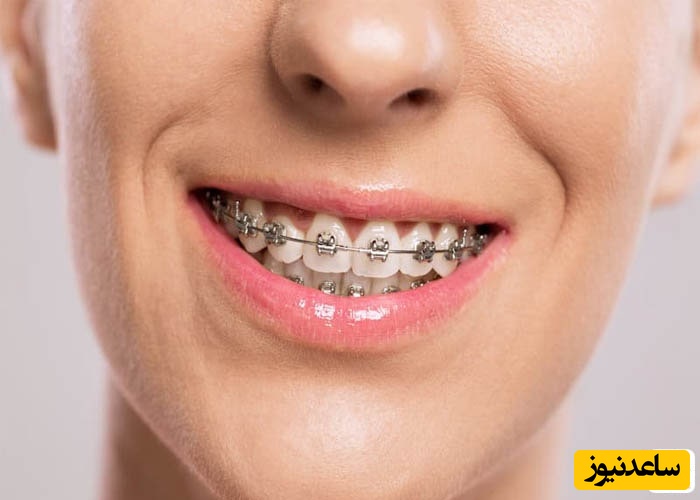 پاسخ به پرسش هایی متداول در مورد ارتودنسی دیمون