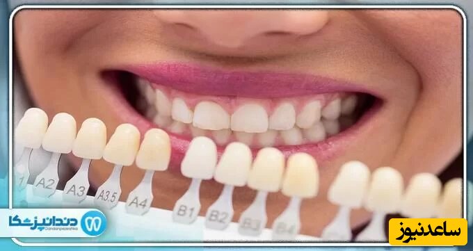 آیا لمینت باعث پوسیدگی دندان ها می شود؟