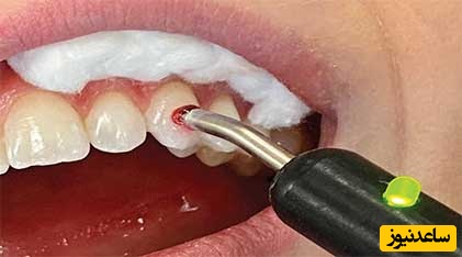 دلیل انجام تست پالپ قبل از عصب کشی چیست؟