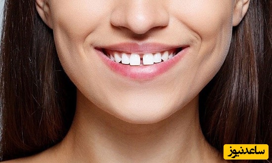 روش های درمان دندان های فاصله دار