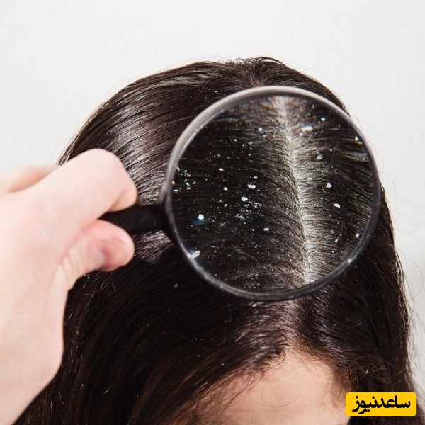 این مشکل مو 50٪ مردم را درگیر می‌کند!/ نشانه‌ای که هر روز می‌بینید اما شاید نادیده می‌گیرید! +ویدیو