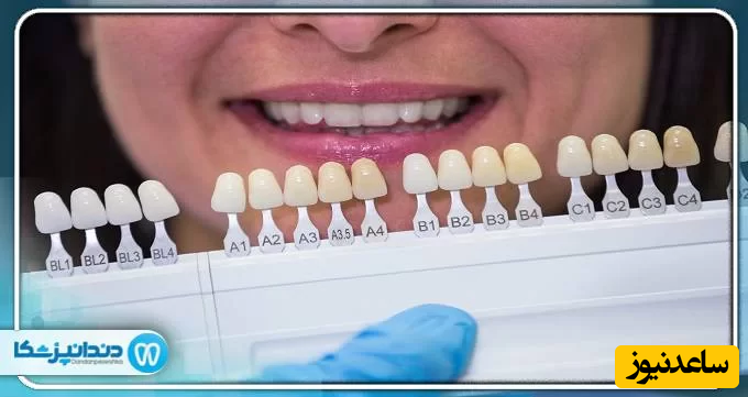 ویژگی های بهترین دکتر لمینت