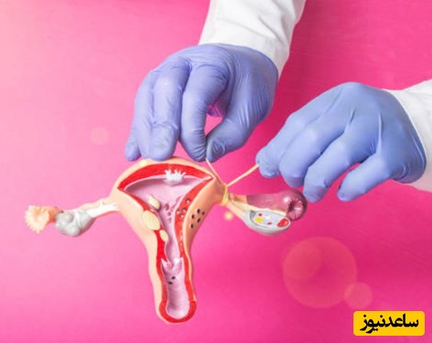 بستن لوله های رحم
