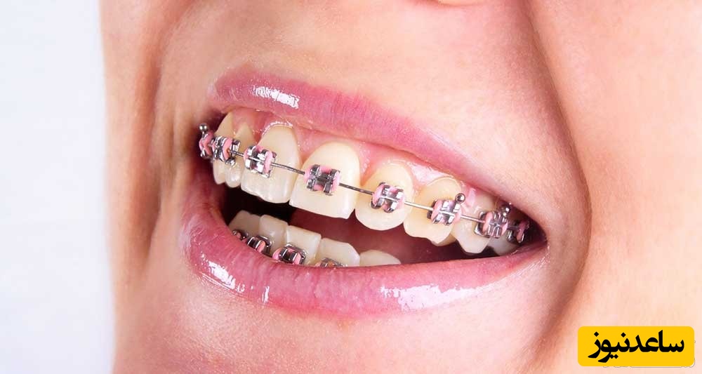 5 خطر احتمالی پلاک های فلزی اورتودنسی بر دندان