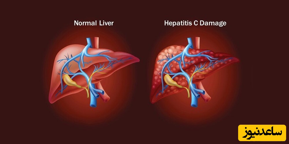 هپاتیت C در دندانپزشکی