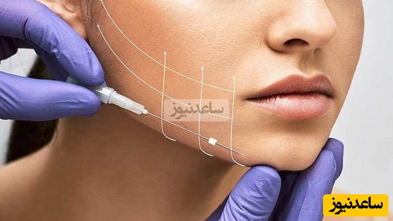 اندولیفت یا هایفو؟ کدام روش برای رفع غبغب و زاویه سازی فک شما معجزه می‌ کند؟