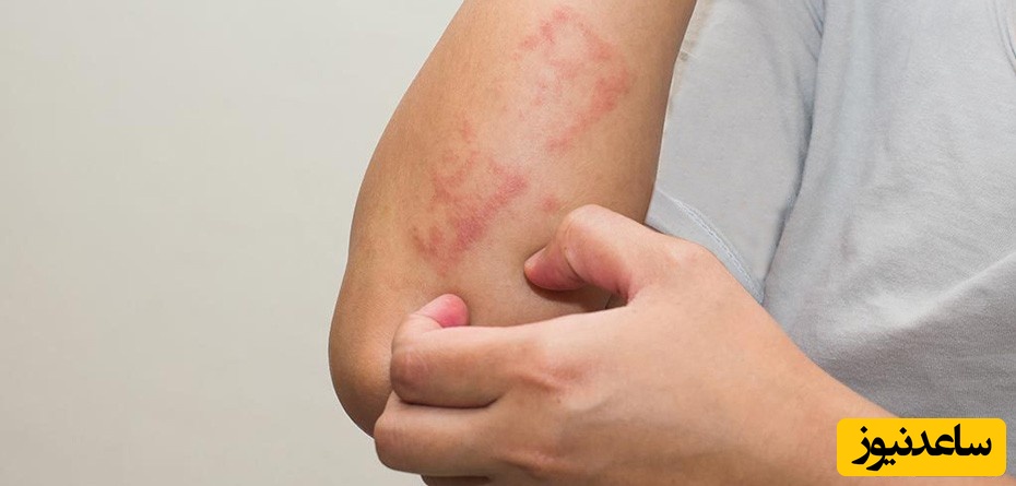 روش های درمان اگزما در دوران بارداری