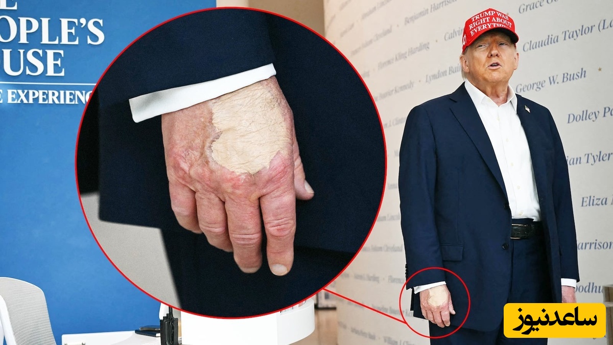 کرم‌پودر ملانیا جواب نداد؛ ترامپ دیروز کبودی دستش را اینگونه پنهان کرد!+ ویدیو