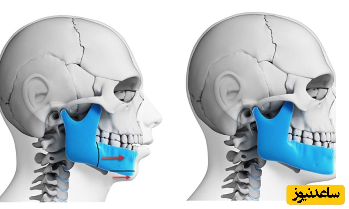 مراحل جراحی انحراف فک چیست؟