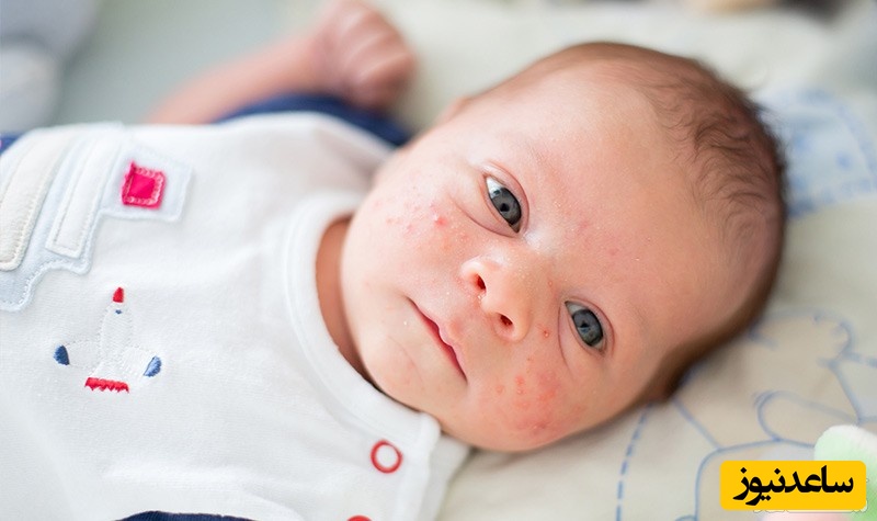 میلیا یا لکه های شیری در نوزادان چیست؟