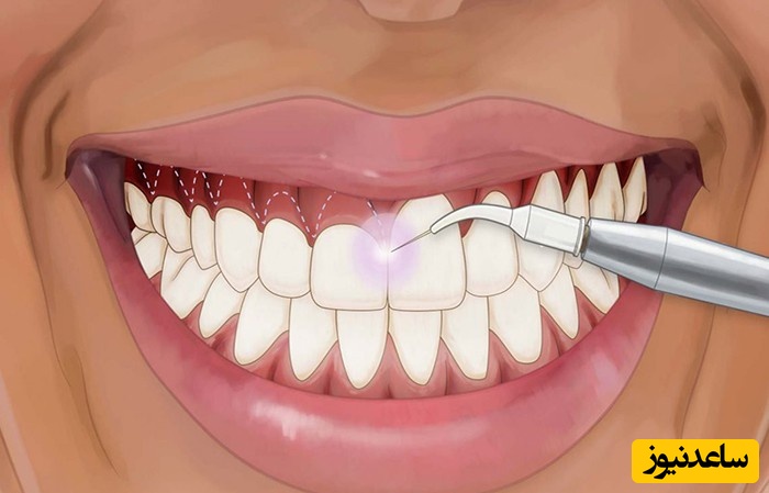 لیفت لثه با لیزر بهتر است یا تیغ جراحی؟