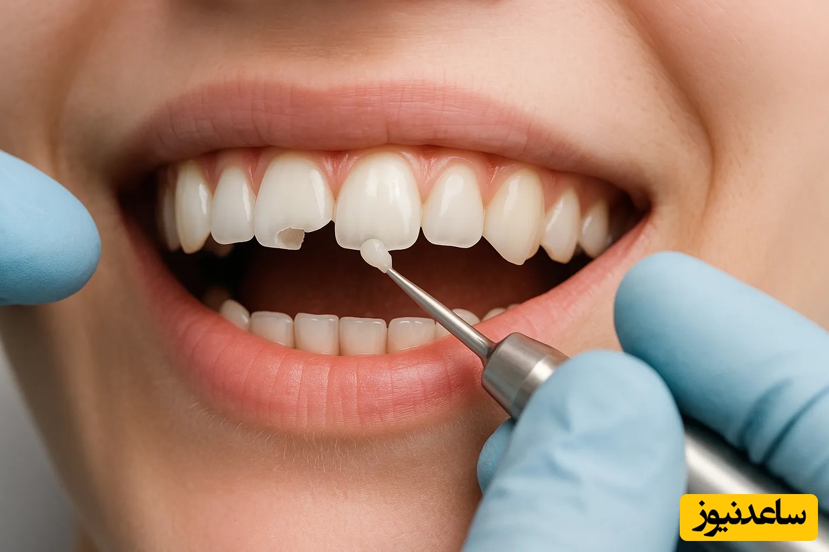 سوالات متداول ترمیم دندان شکسته