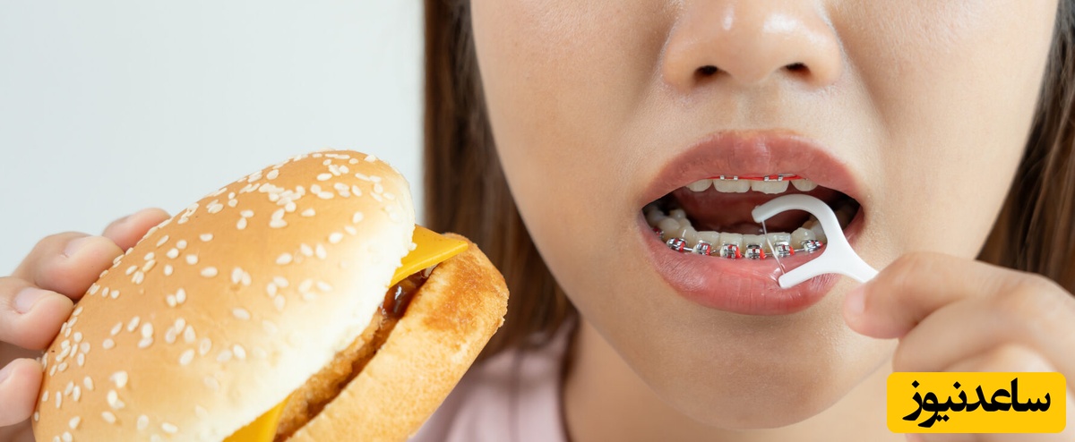  تغذیه در حین درمان ارتودنسی و نکات مهم در مورد آن