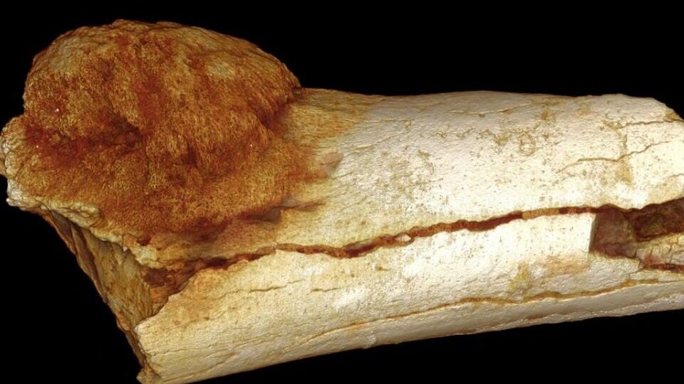 قدیمی‌ترین مورد «سرطان» کشف شد؛ 1 میلیون و 700 هزار سال قبل!