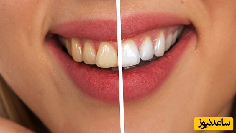 علل موثر در تغییر رنگ دندان ها