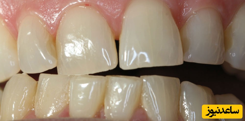 وجود فاصله در بین دندانها + سوالات متداول