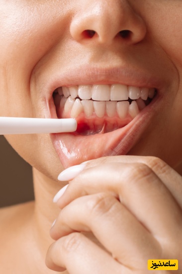 روشهای مختلف برای جراحی لثه