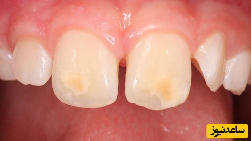علت ایجاد لکه‌های مختلف روی دندان