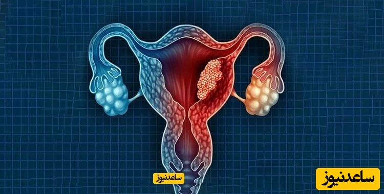 کیست پارااوارین تخمدان چیست و چه علائمی دارد؟