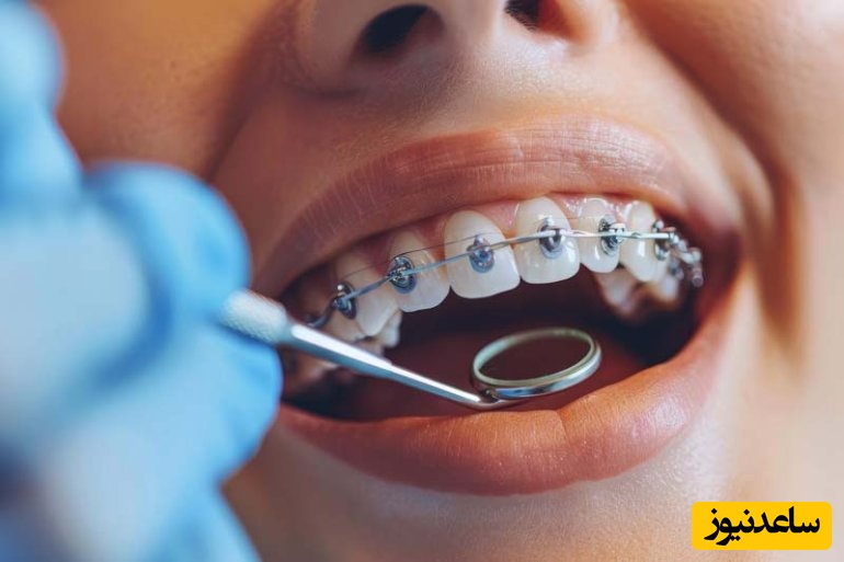 مهمترین سوالات متداول ارتودنسی ثابت
