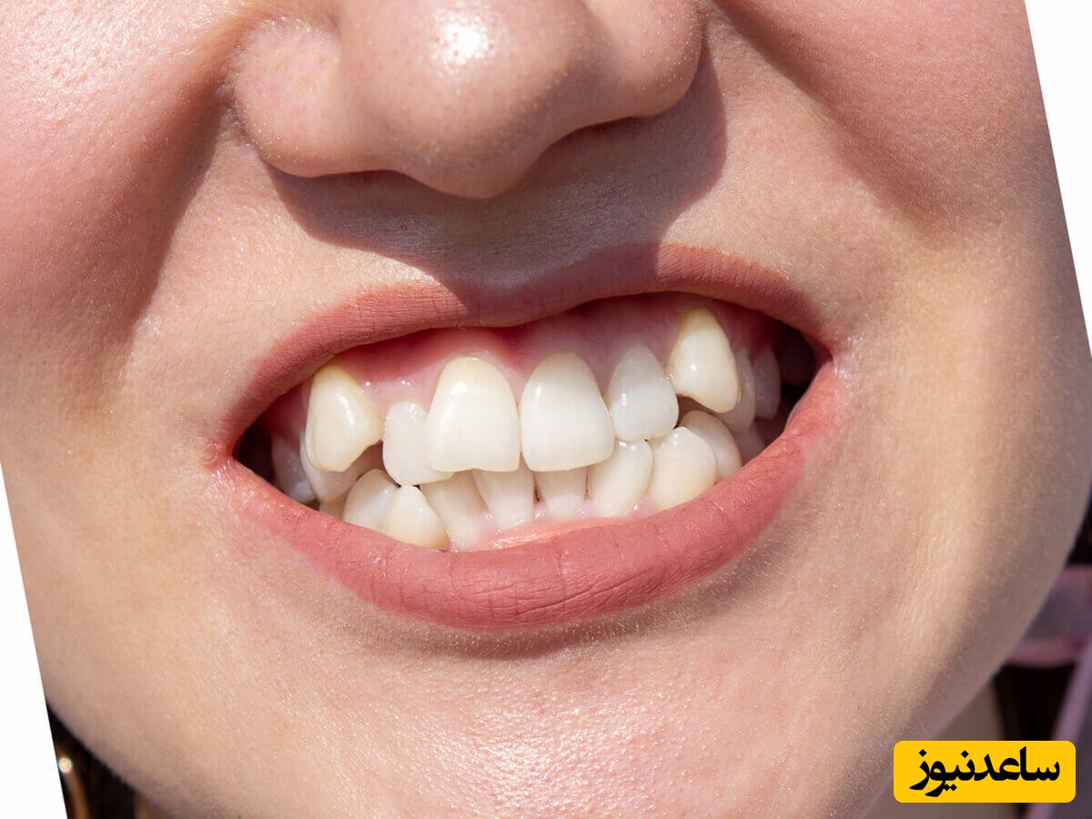 بی‌نظمی دندان ها چگونه درمان می‌شود؟