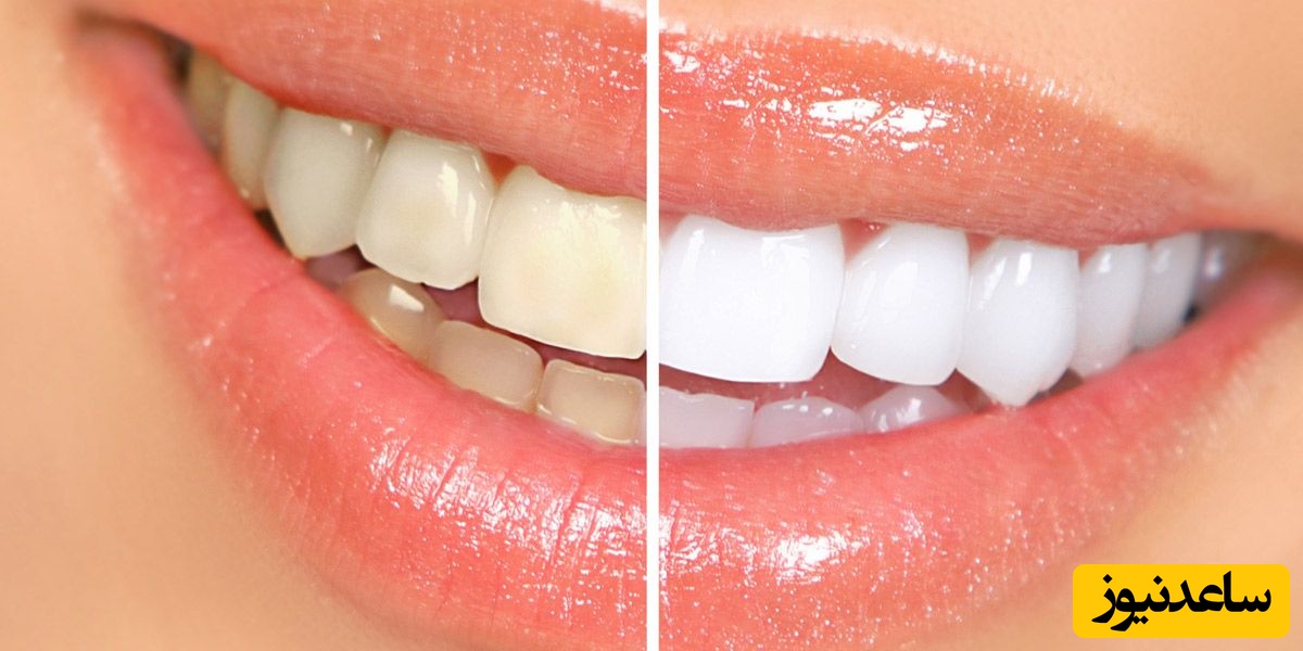 چگونه می‌توان از ایجاد تغییر رنگ در دندان کودکان جلوگیری نمود؟