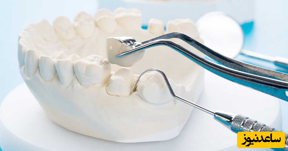 مهمترین عوارض روکش دندان