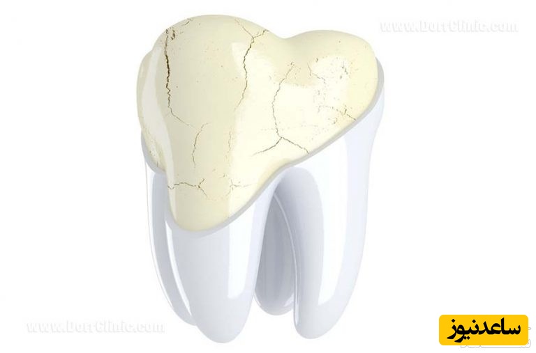 دندان سایش یافته چیست و انواع آن؟