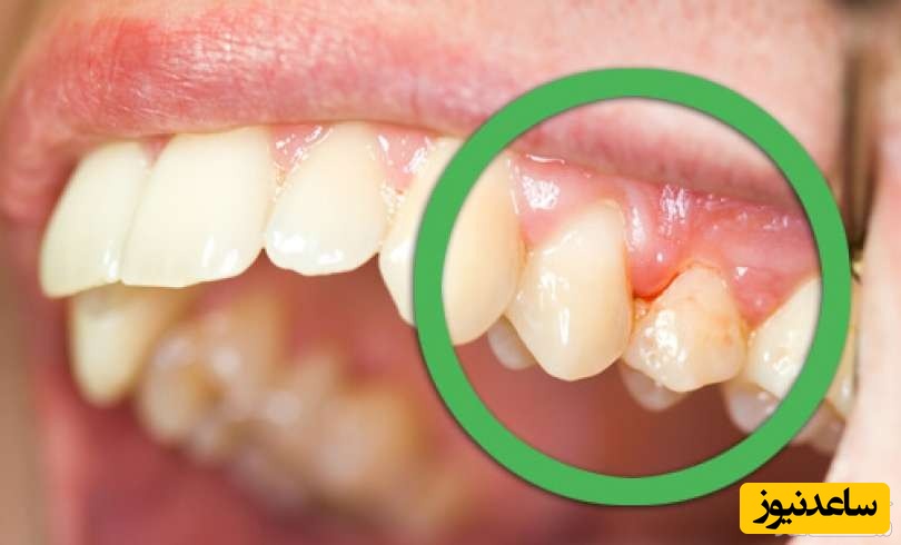 درمان عفونت لثه بعد از عمل