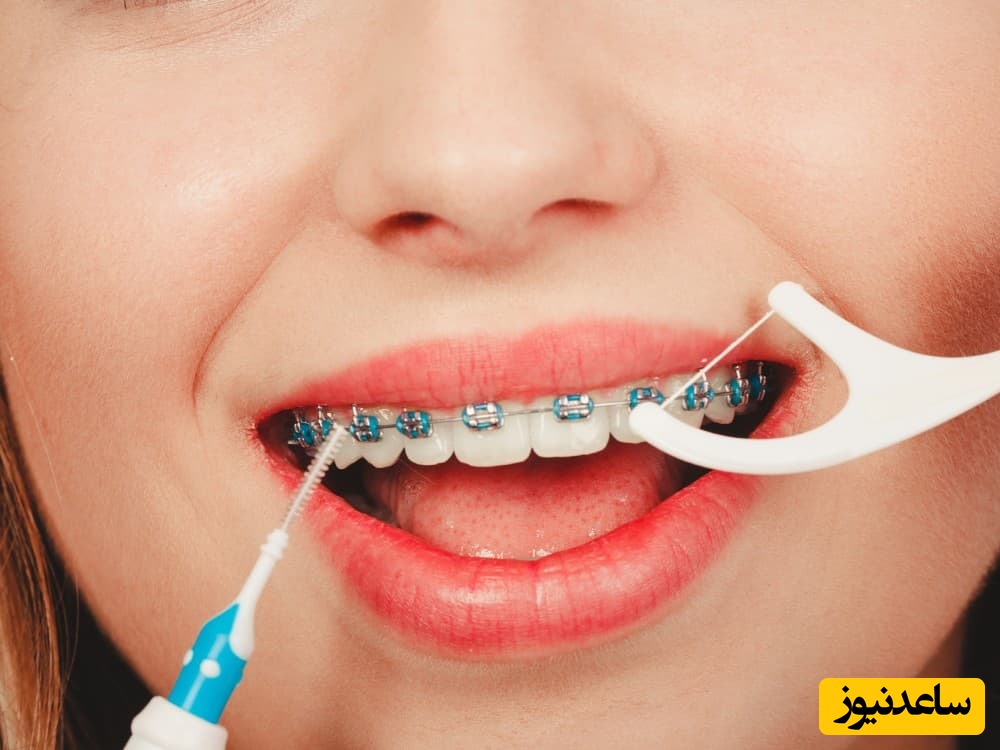 چرا کشیدن نخ دندان مهم است وقتی ارتودنسی دارید؟ 