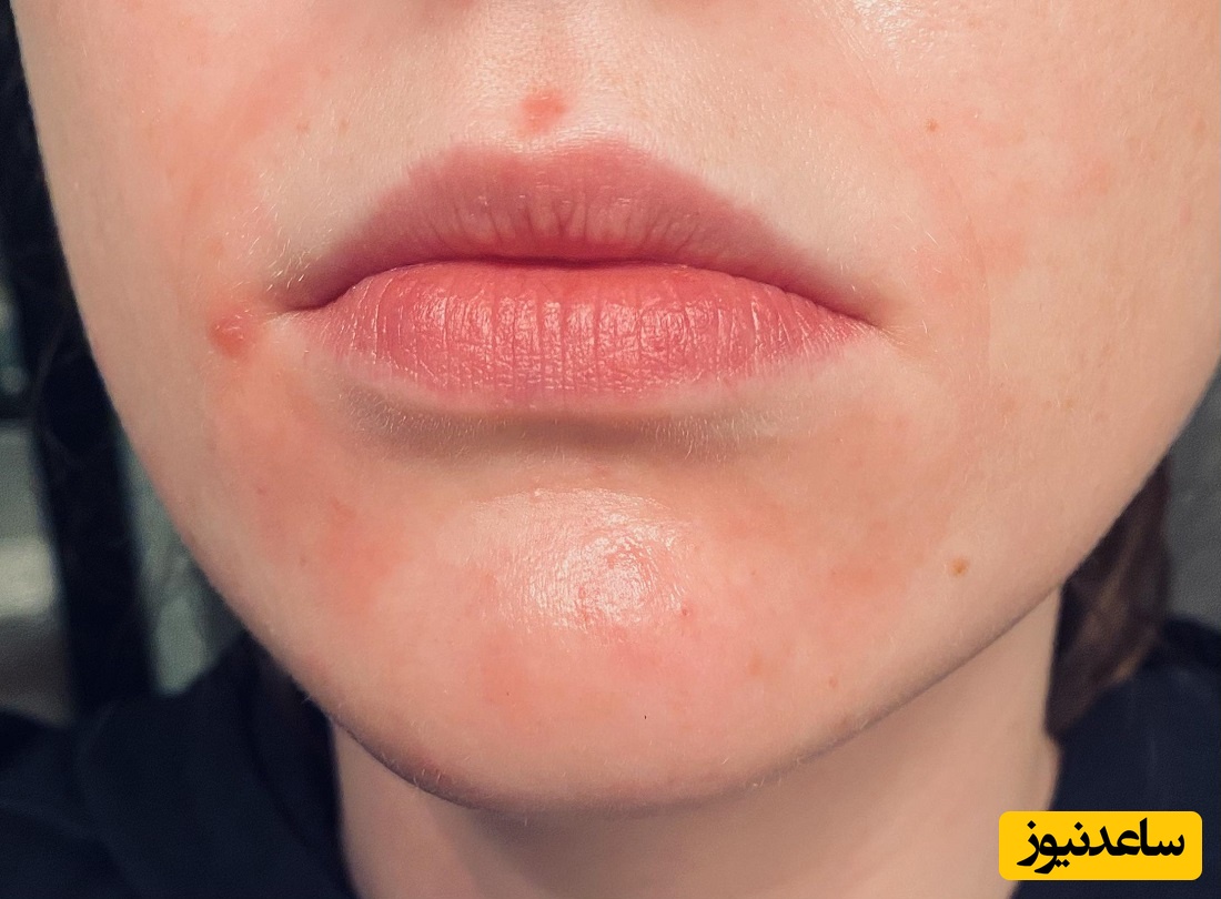 درمان درماتیت پریورال چیست؟