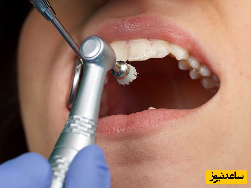 فواید جرم گیری دندان چیست؟