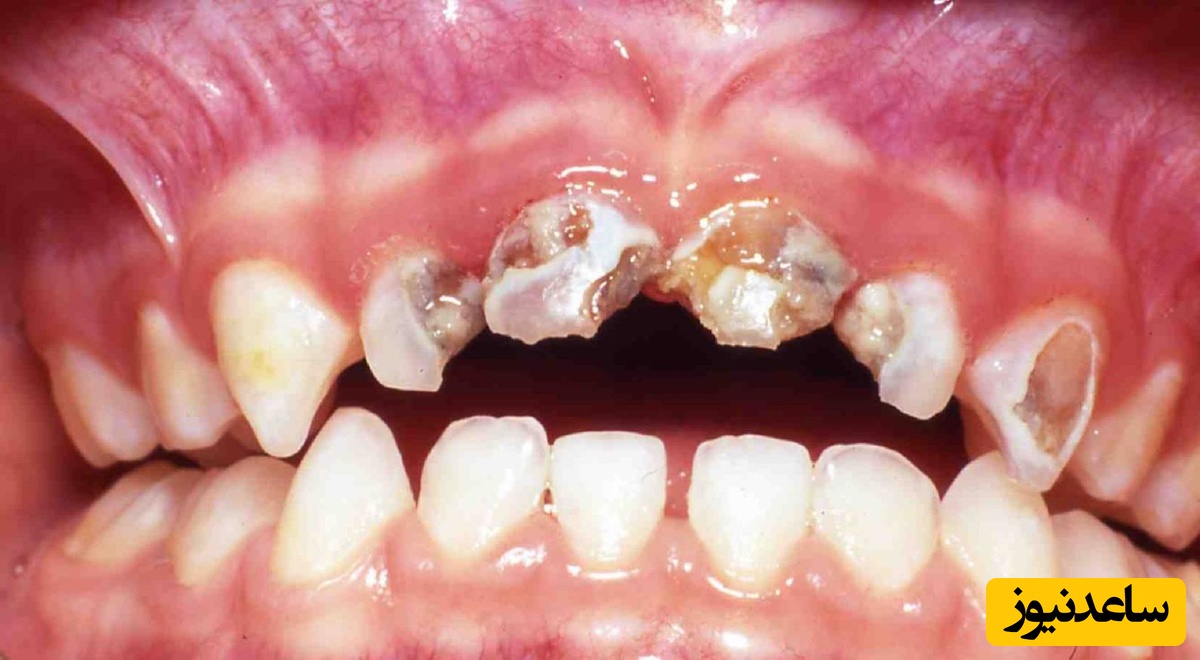 علت پوسیدگی دندان کودک چیست ؟