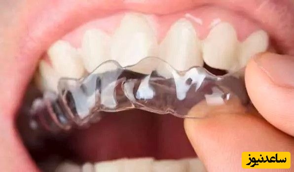 کاربرد ارتودنسی نامرئی چیست؟