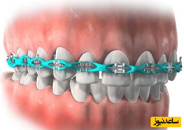 در انواع ارتودنسی کدام دستگاه ها به کار می روند؟