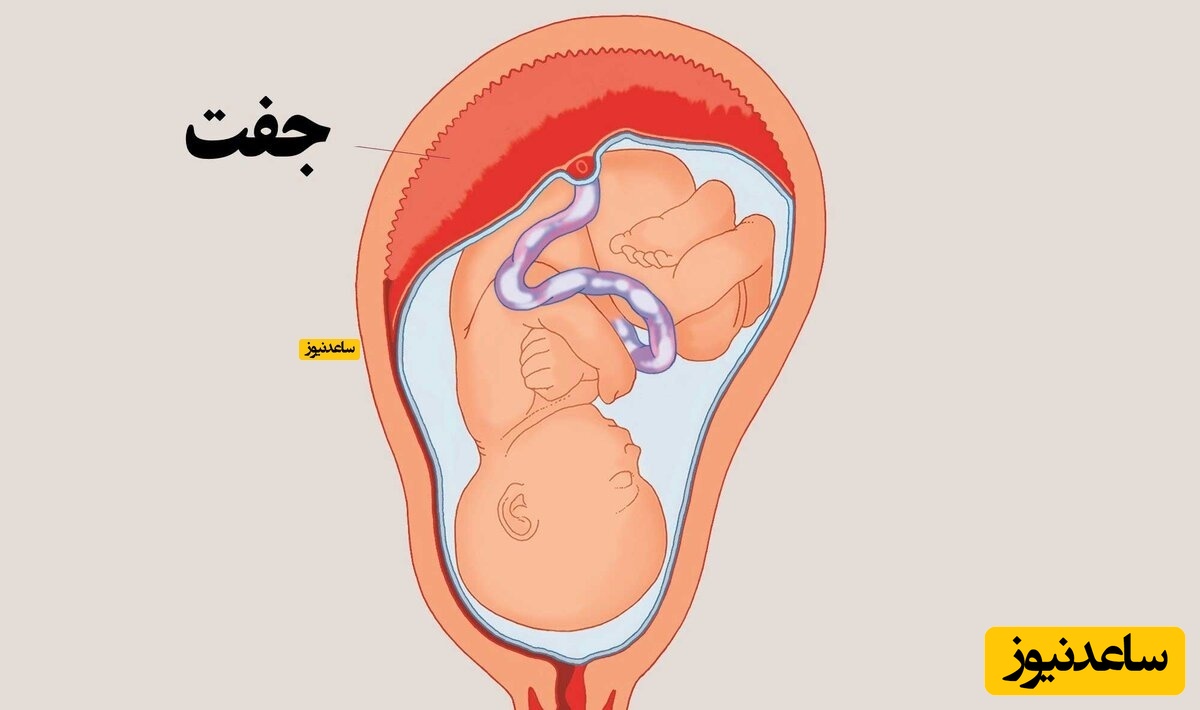 علل و علائم جدا شدن زودرس جفت جنین از رحم