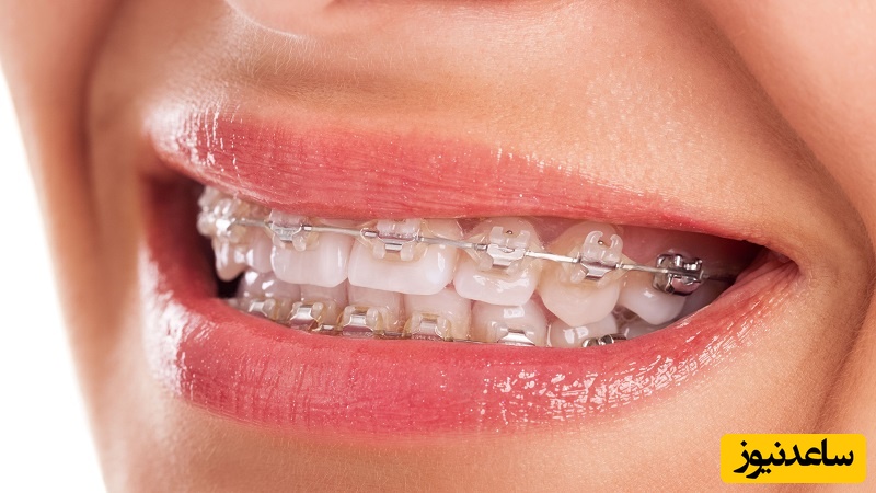 آیا براکت سرامیکی برای من مناسب است؟