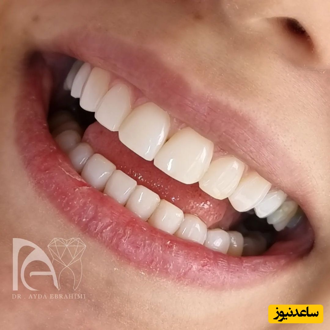 چرا از انجام کامپوزیت دندان باید خودداری کرد؟