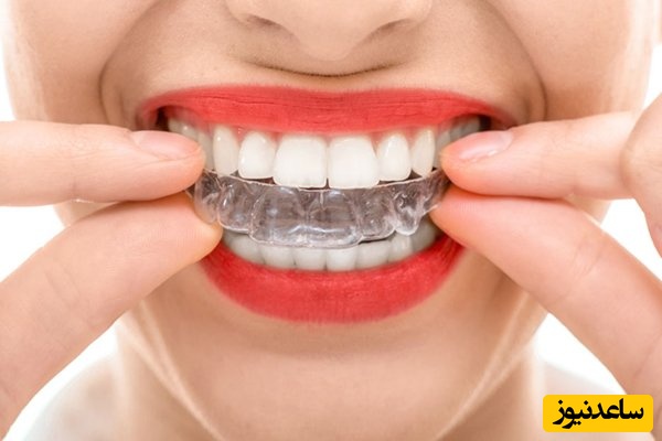 4 مورد از ویژگی های ارتودنسی سرامیکی که باید بدانید!