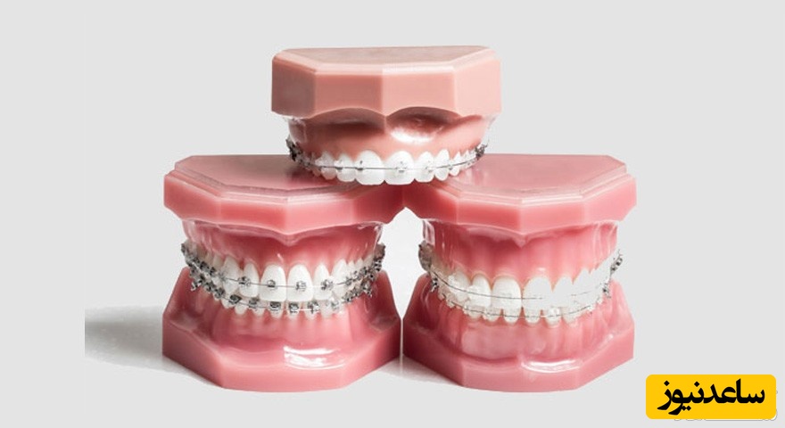 انواع ریتینرها در ارتودنسی