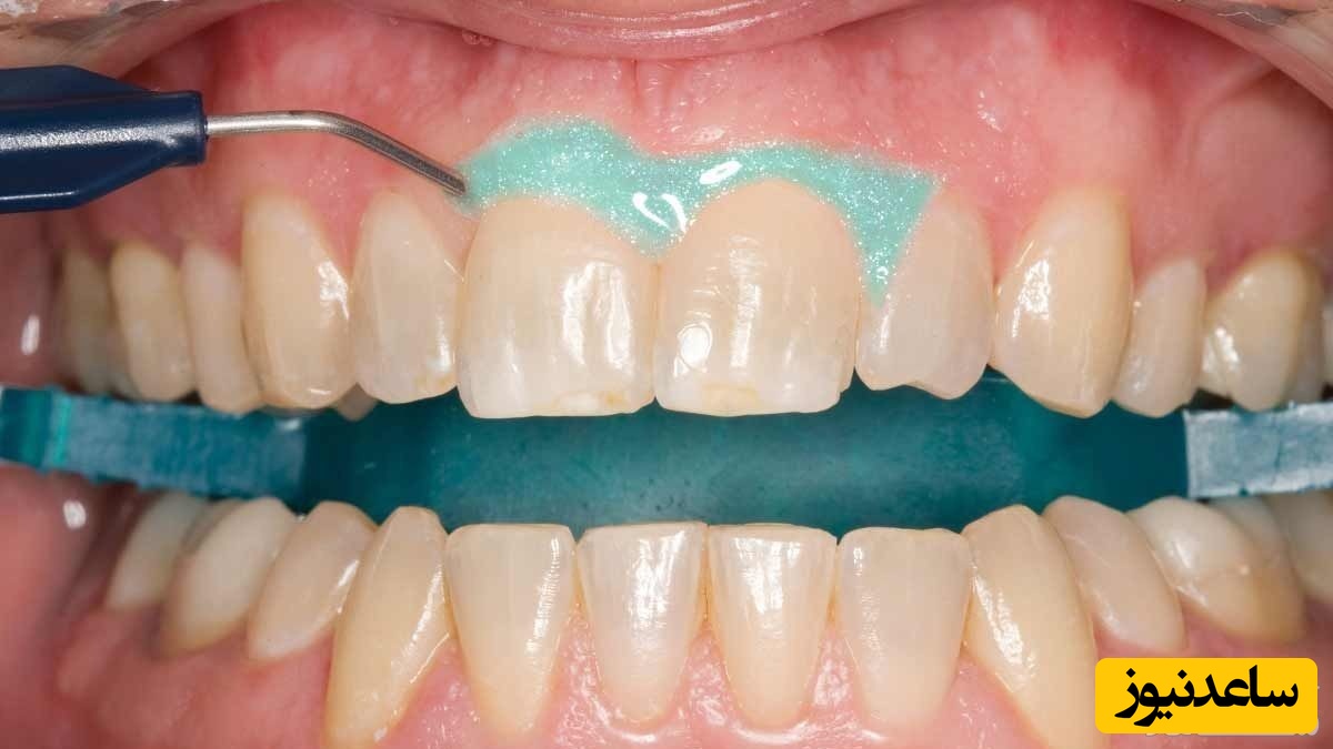 مراحل جرمگیری دندان چیست؟