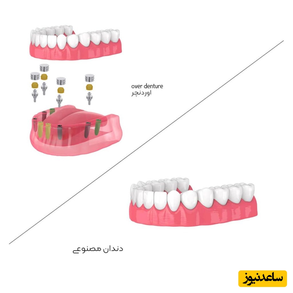 مزیت دندان مصنوعی بر پایه ی ایمپلنت چیست؟