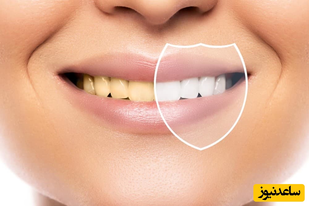 سفید کردن دندان پس از ارتودنسی به روش کلینیکی