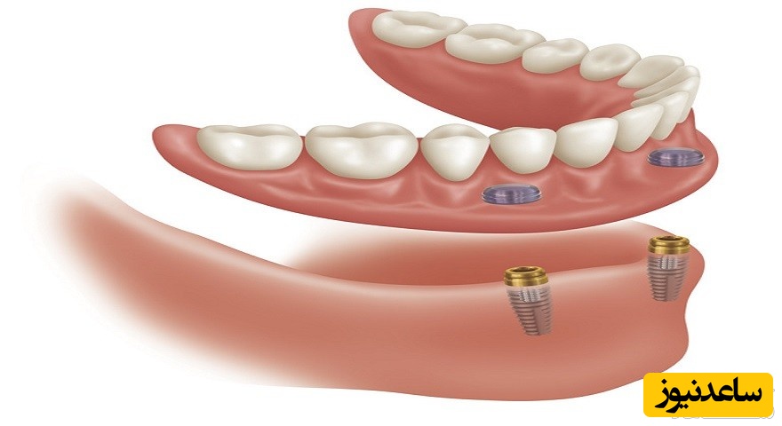 دندان مصنوعی کاملا ثابت چیست؟