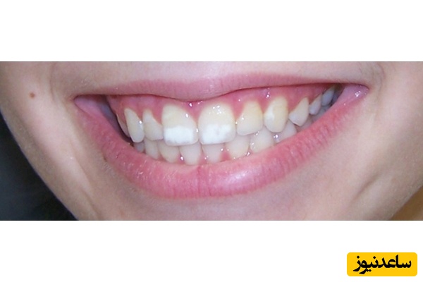 کدام توصیه های بهداشتی برای جلوگیری لک دندان بعد از ارتودنسی لازم است؟