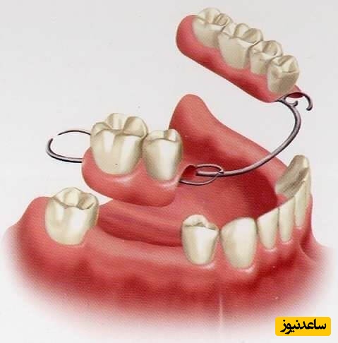آشنایی با انواع بریج دندان