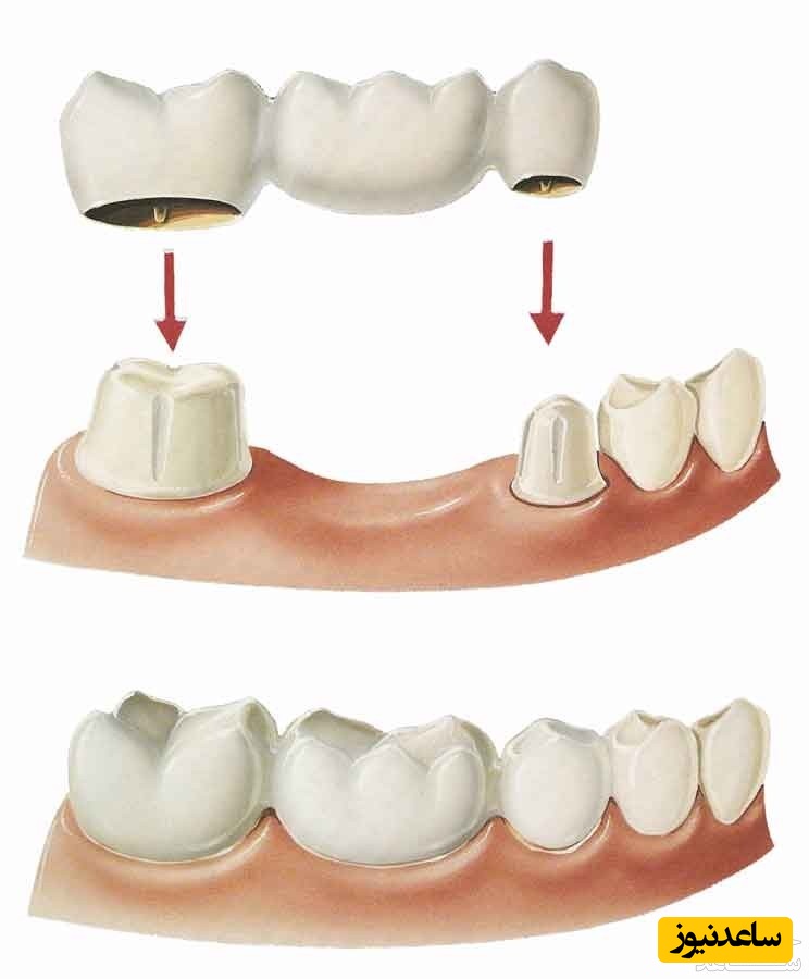 چگونه ایمپلنت دندان میتواند به شما جوانی ببخشد؟