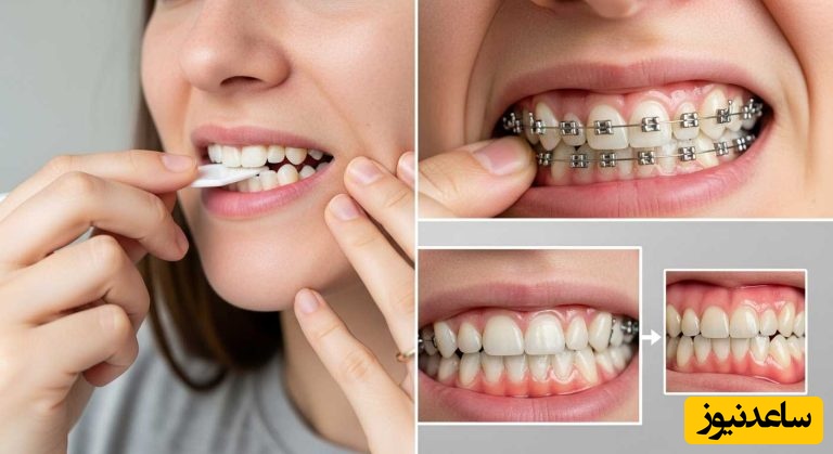 بخش های مختلف کش ارتودنسی چیست؟